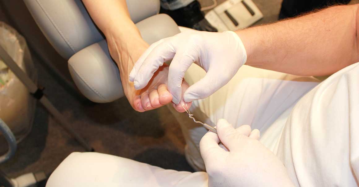  Da li je onihomikoza noktiju i tvoj problem?