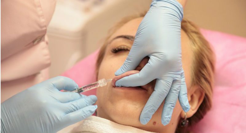  Hijaluron u usnama – Kako do punijih usana brzo?