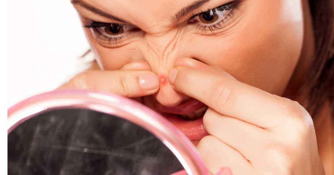  Gnojne bubuljice možeš da rešiš ovim metodama!