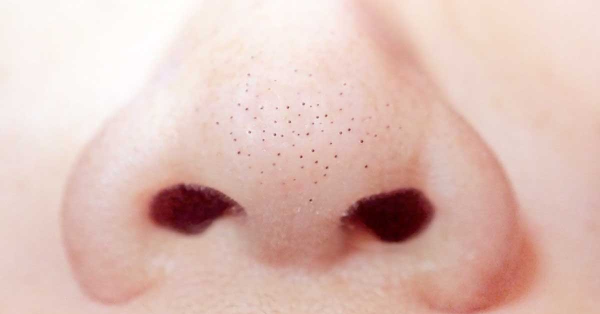 kako očistiti mitisere sa nosa