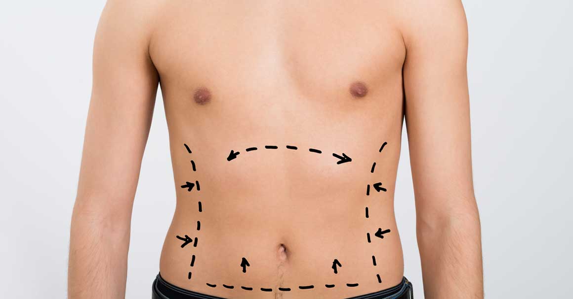  Niste pošteđeni! Celulit kod muškaraca najčešće se javlja na stomaku!