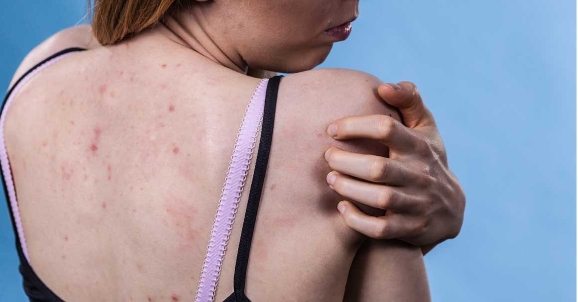  Bubuljice na leđima nestaće na ovaj način!