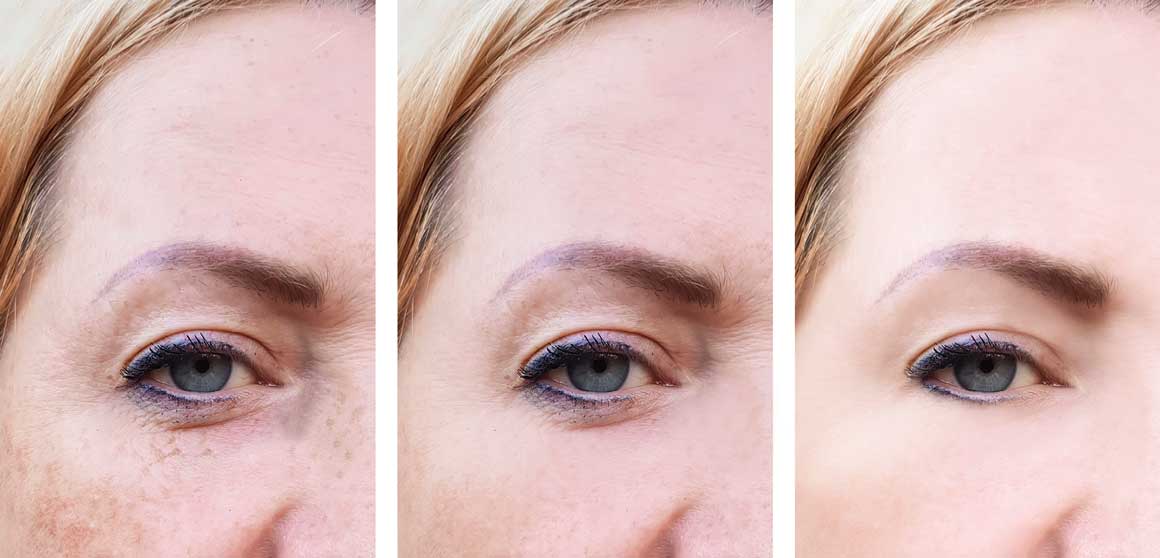 zašto se pojavljuju fleke na koži