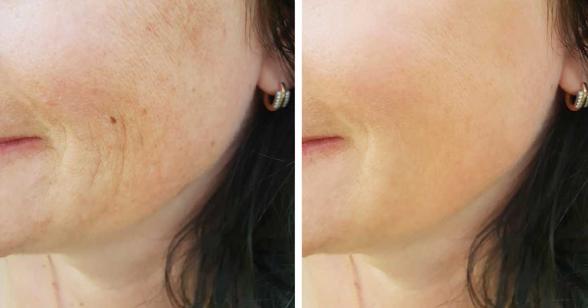  Nazolabijalne bore: krema, vežbe i iskustva!