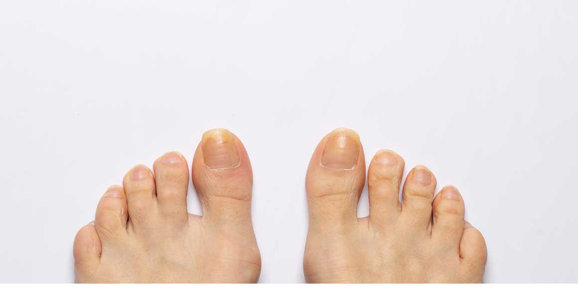  Žuti nokti na nogama? Odmah reaguj ovako!