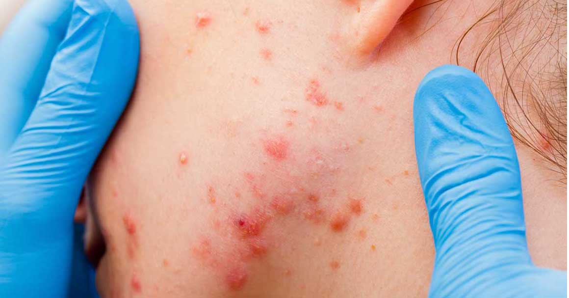  Velike bubuljice ti više neće zadavati muke!Prati ove savete!