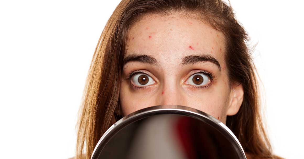  Majorka akne nisu razlog za brigu!