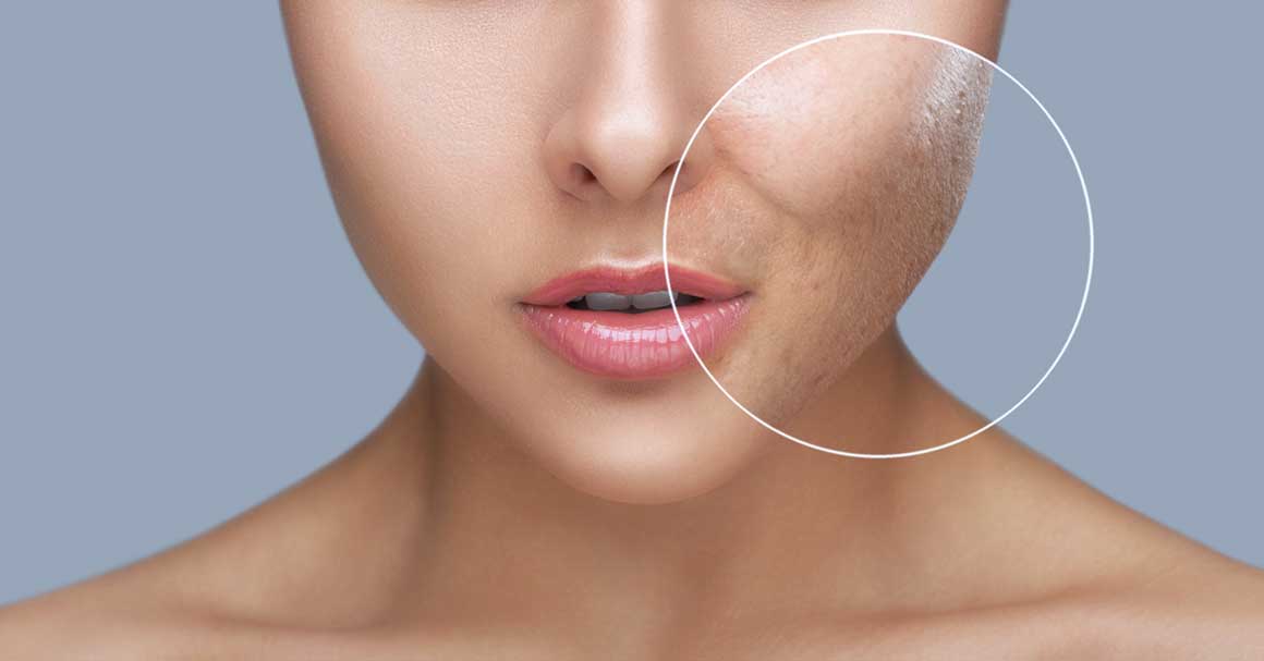  Ožiljci od bubuljica nestaju na ovaj način!