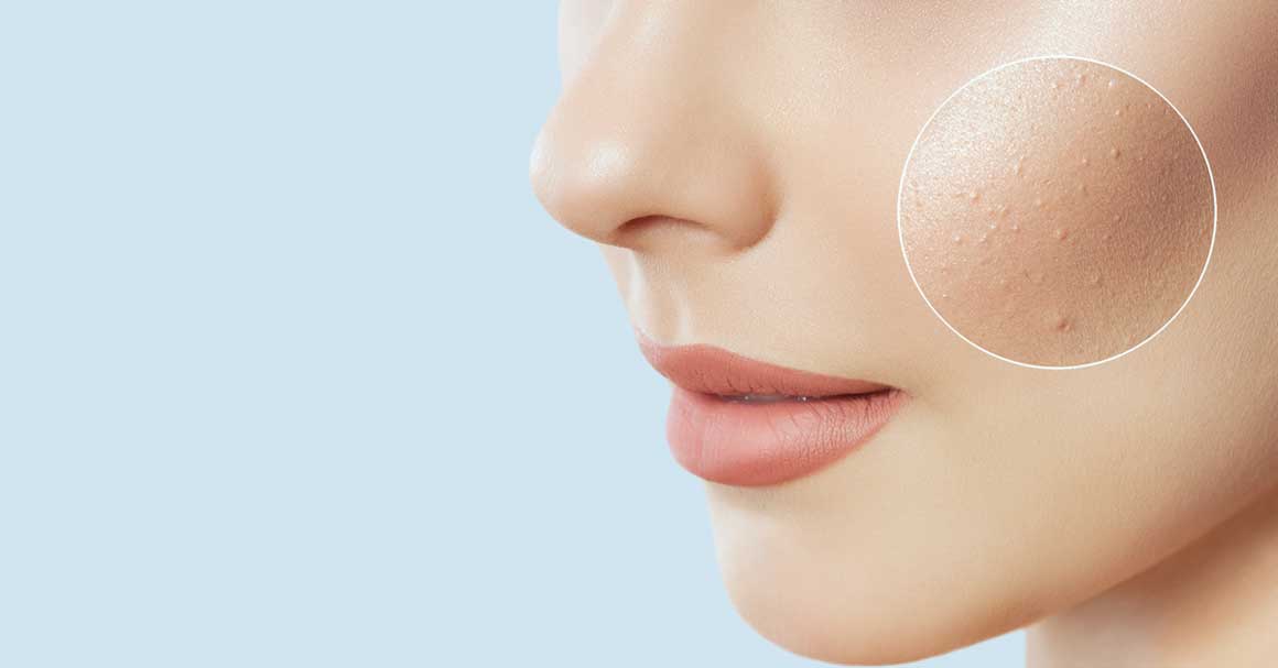 sitne bubuljice po licu