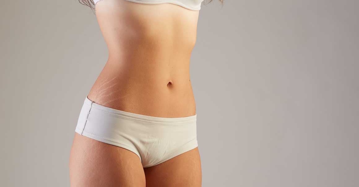  Zašto i kako nastaju strije?