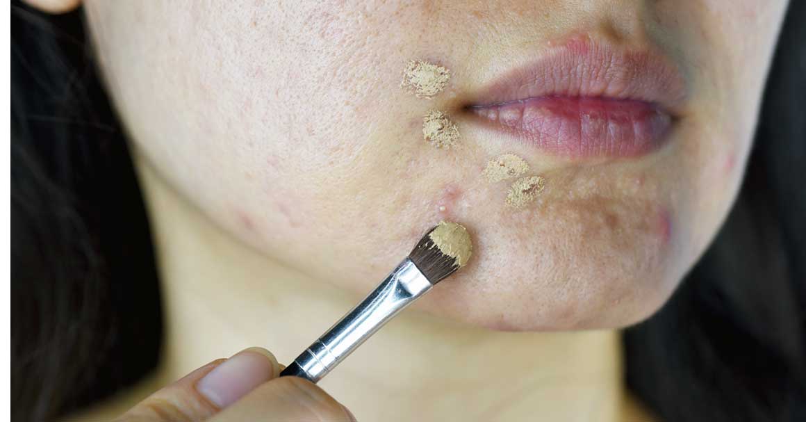  Izaberi dobar korektor za bubuljice uz ove savete!