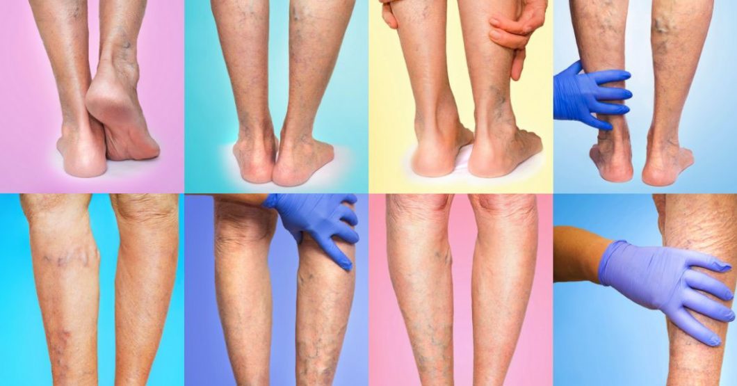  Varikozne vene – uzroci i kada je vreme da se zabrineš?