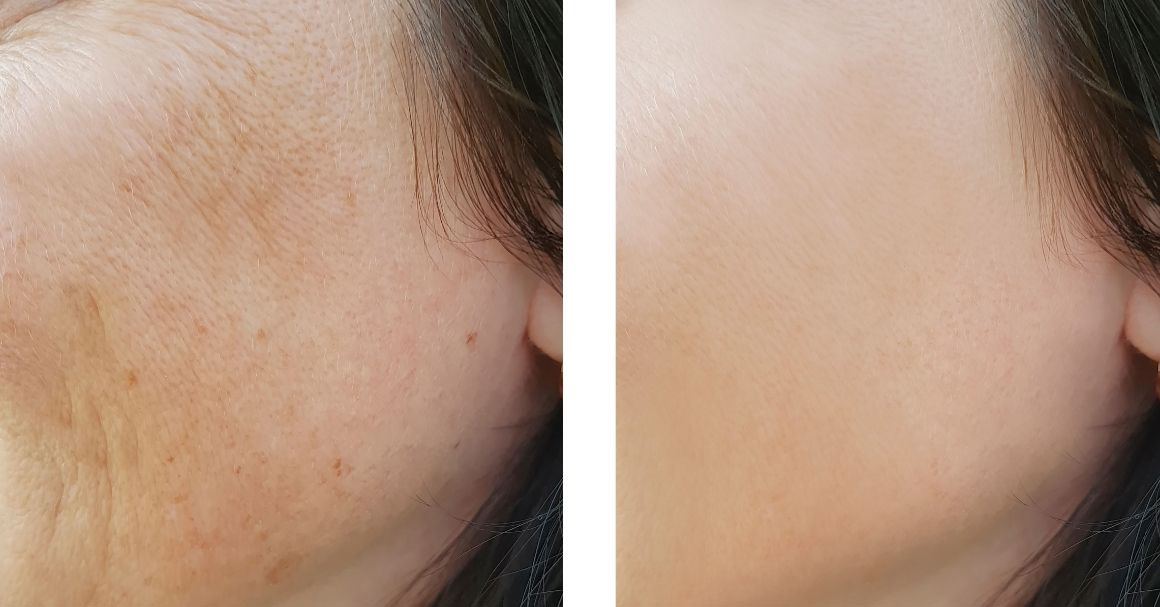  Botoks lica! Najpopularniji tretman protiv bora!