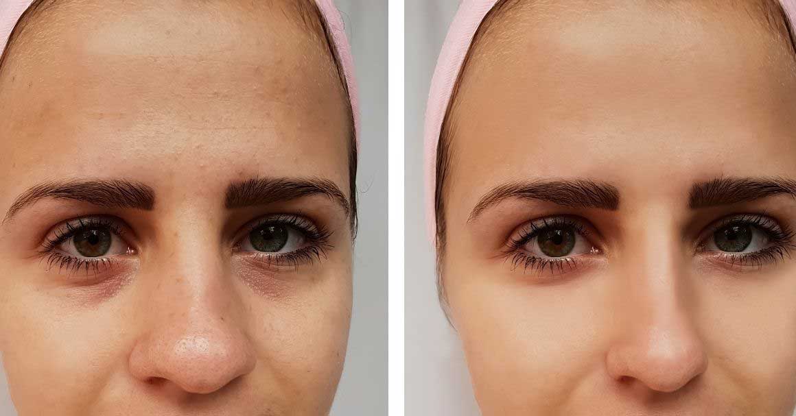 nehirurška korekcija nosa