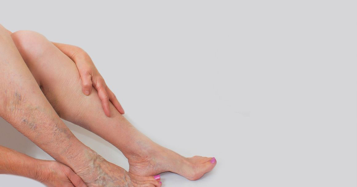  Zašto se javljaju proširene vene kod mladih ljudi?