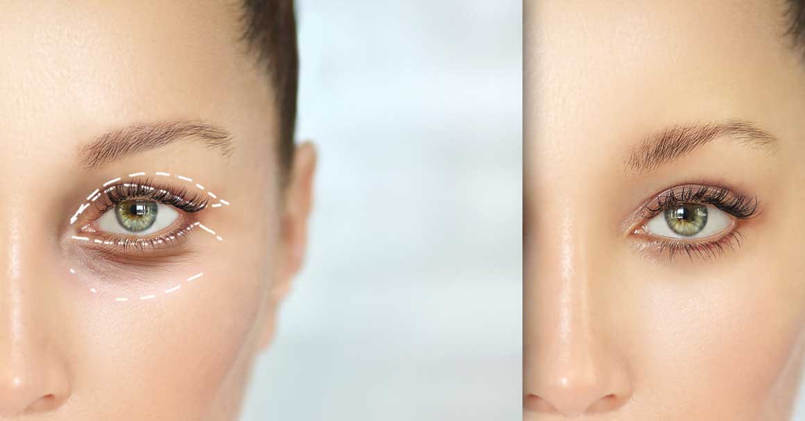 blefaroplastika