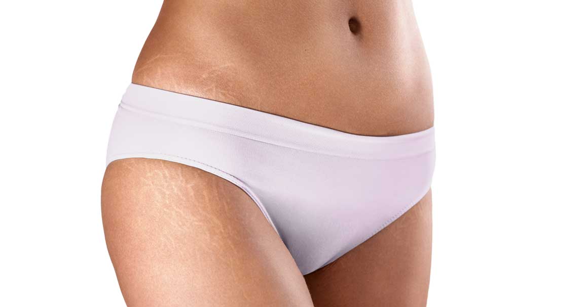  Konačno saznaj kako ukloniti bele strije!