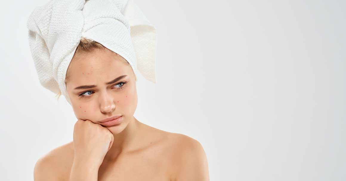  Kako da ukloniš bele bubuljice na licu, konačno?!