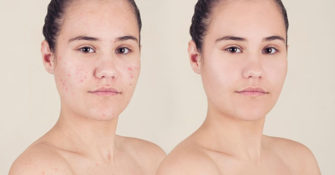  Ishrana protiv bubuljica – prati ova pravila!