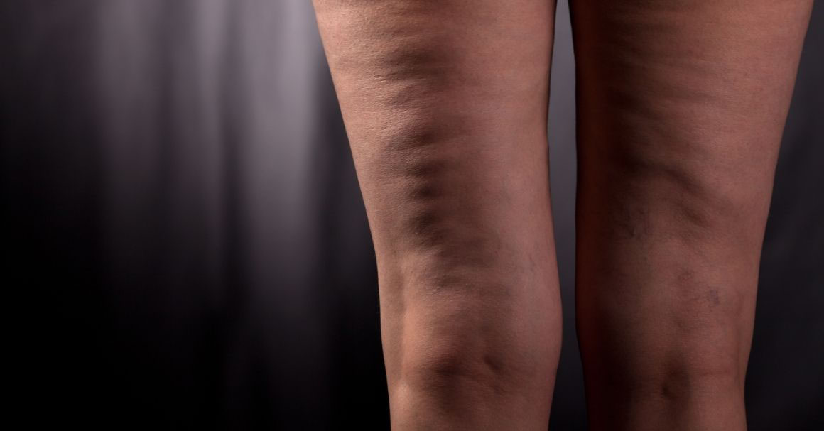  Adipozni celulit! Kakva je to sad napast?