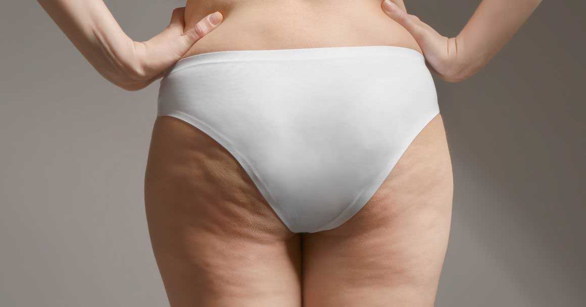  Kako ukloniti celulit na površini kože?