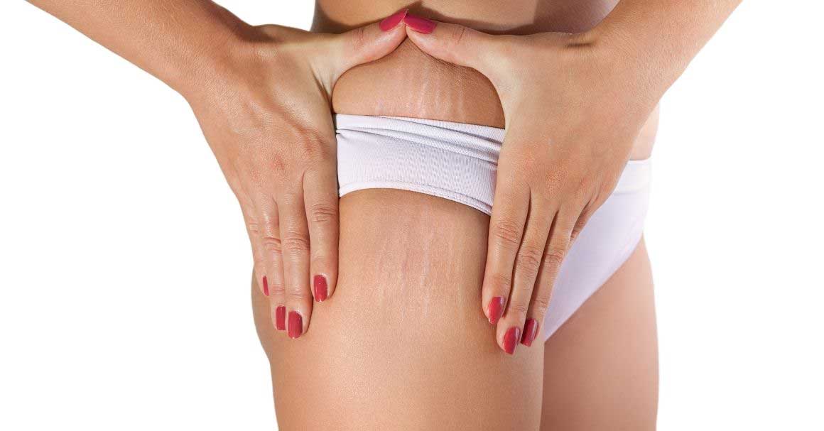  Kurkuma za strije!Još jedan čaroban sastojak!