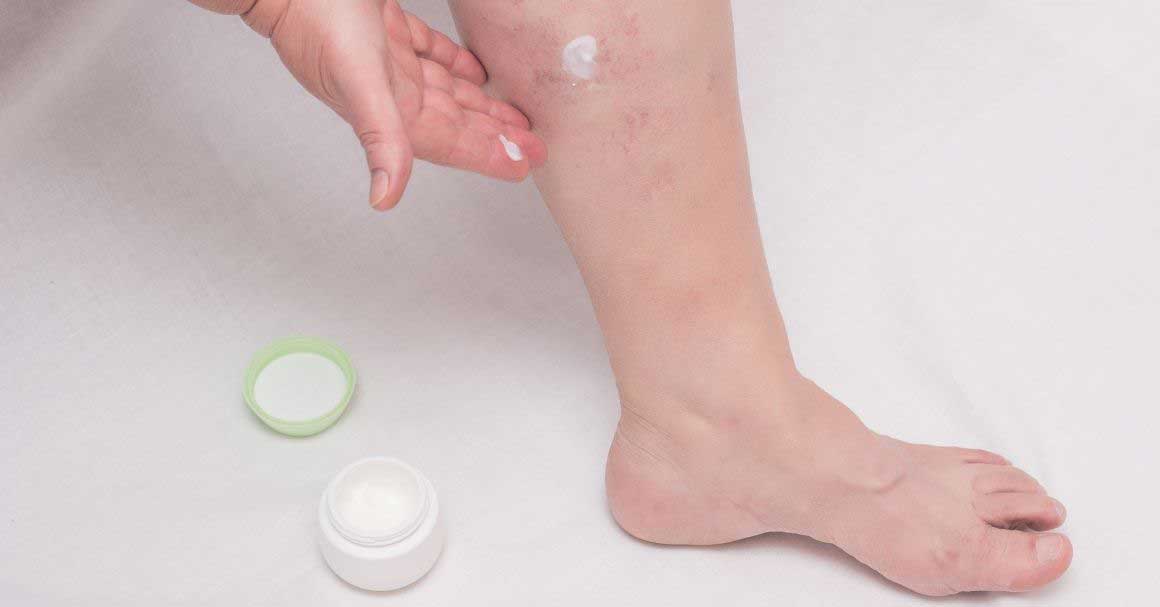  Koji prirodni lek za vene najbolje ublažava simptome?