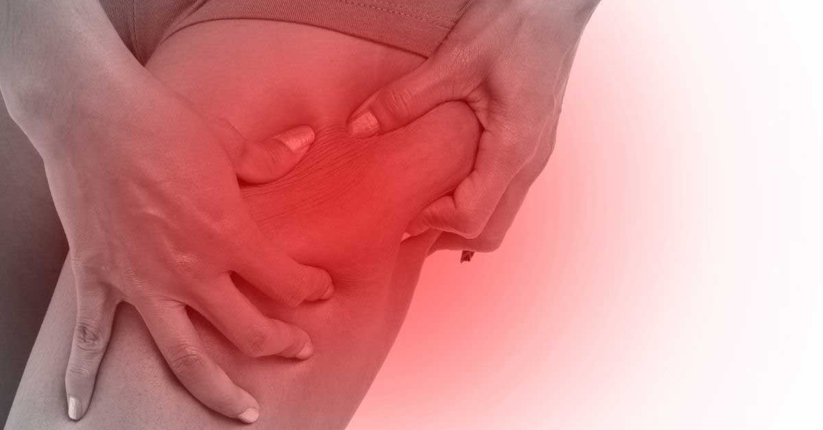  Bolan celulit: bezazlena pojava ili alarm za telo?