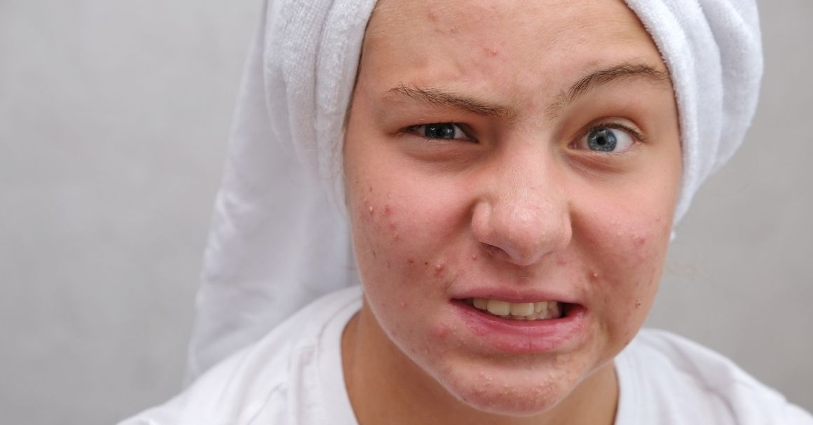  Sveobuhvatan vodič kroz bubuljice u pubertetu