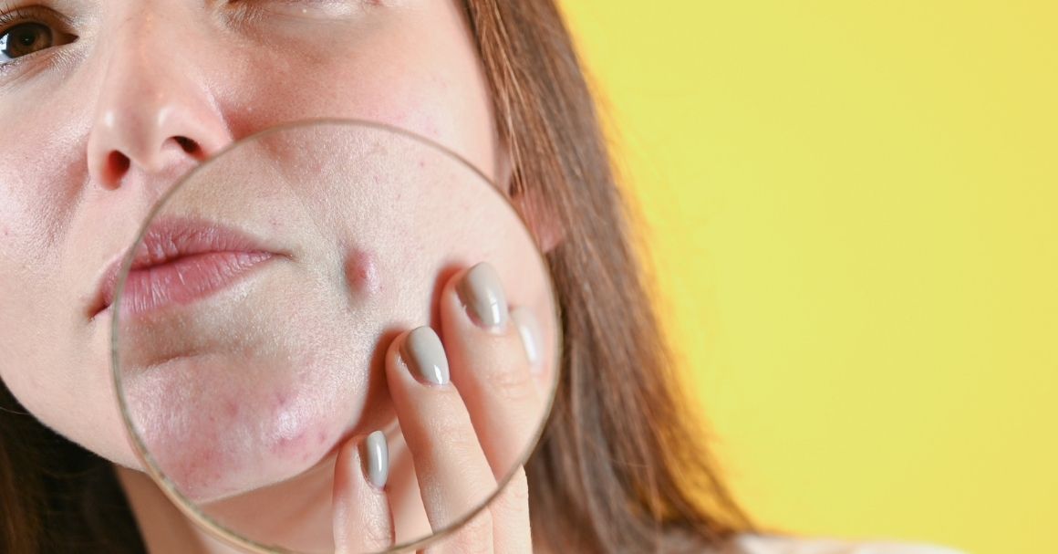  Cistične akne: Sa njima nije šala, a ovako se leče!