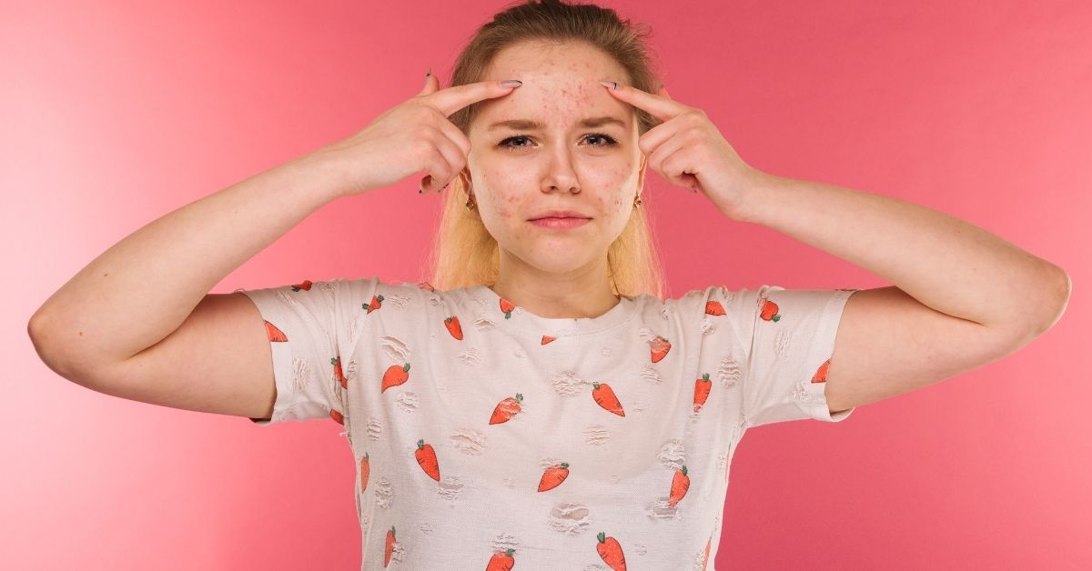  Kako ukloniti bubuljice na licu zauvek?