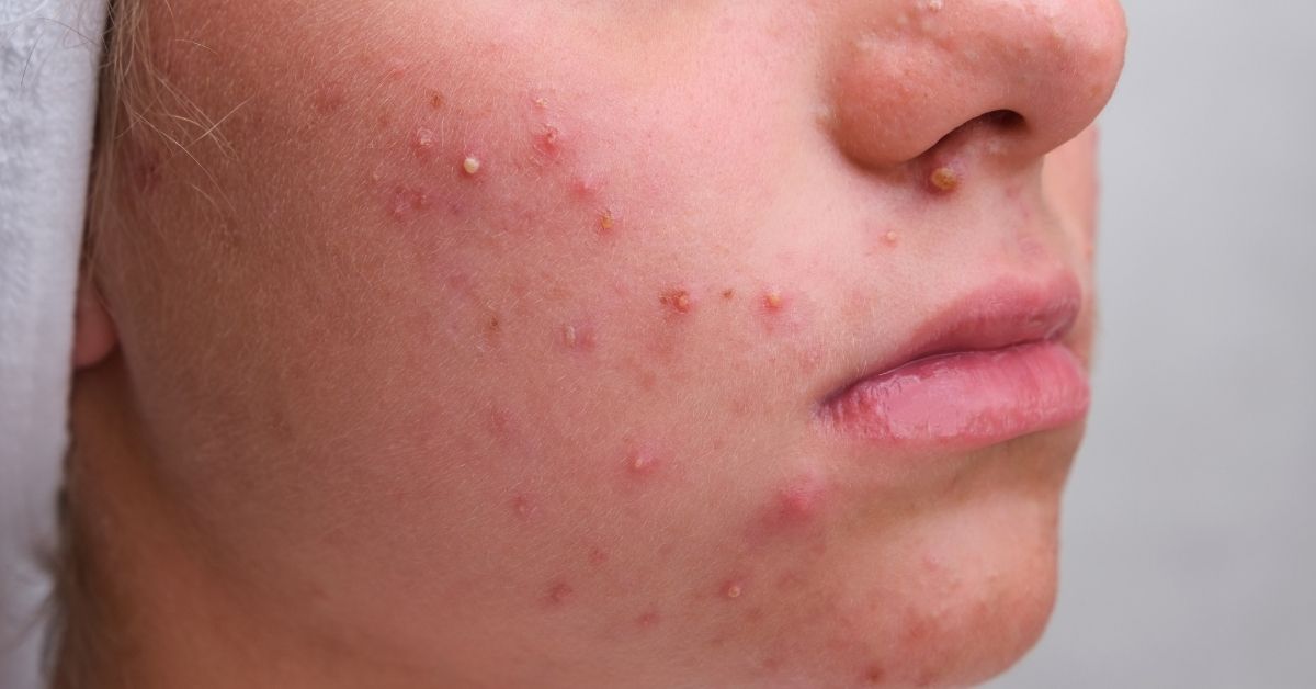  Vodene bubuljice jesu napast, a ovako ih se reši!