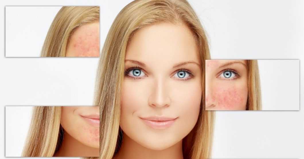  Kako ukloniti crvenilo od bubuljica na licu?