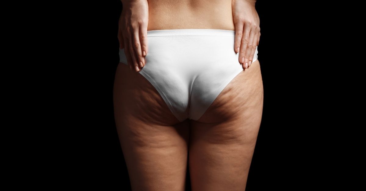  Vodeni celulit nakon ovog teksta neće biti tvoj problem