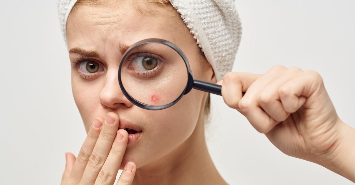  Tvrde bubuljice na licu!Doskoči im ovim trikovima!