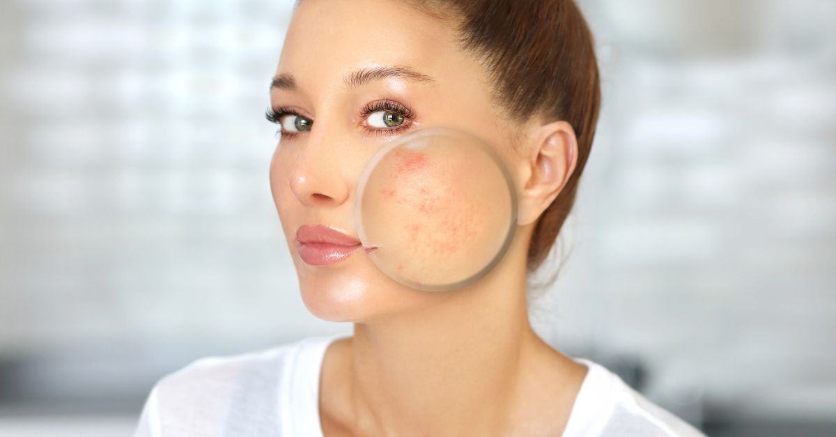 Bakterijske akne: ozbiljan problem koji se da rešiti!