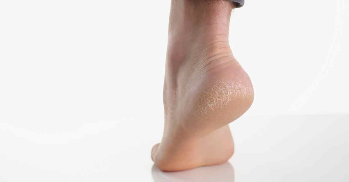  Zaboravi na ispucale pete! Vodič za glatka stopala