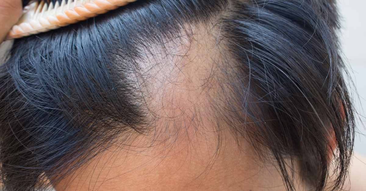  Opadanje kose na pečate: Uzroci, simptomi i lečenje!