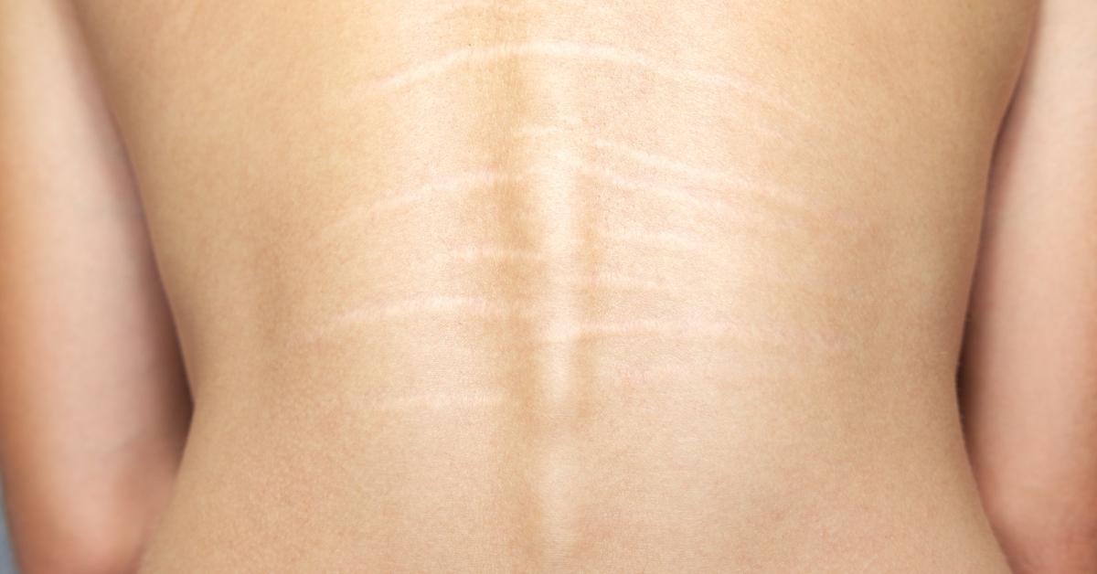  Kako da rešiš strije po leđima?