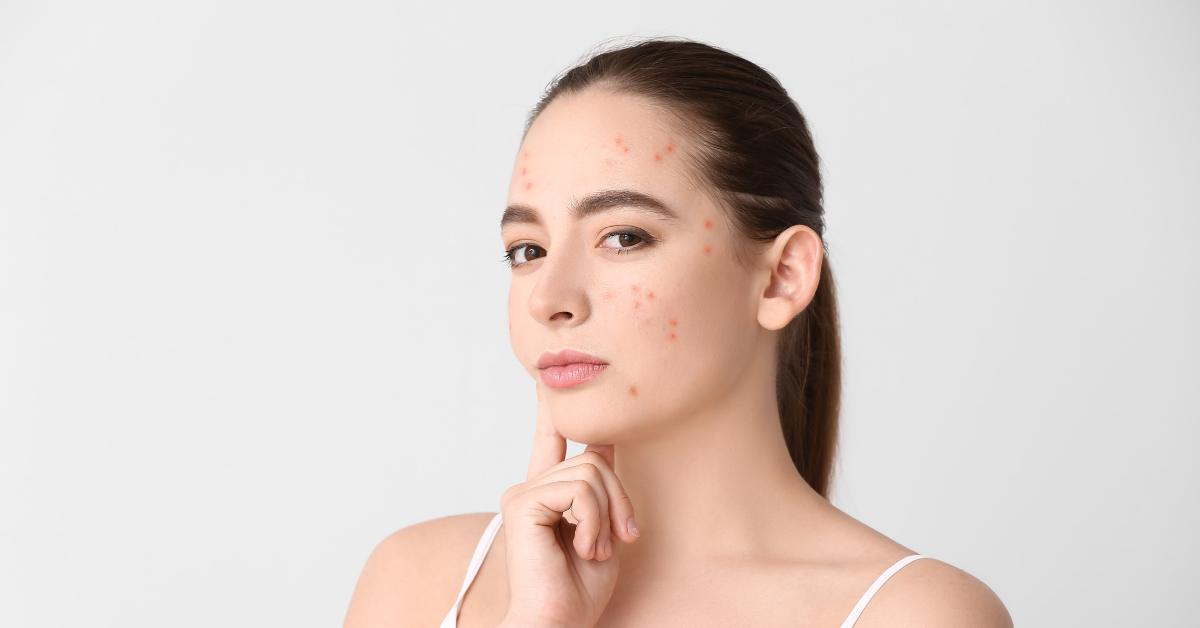  Prepoznaj steroidne akne i reši ih se jednom zauvek!