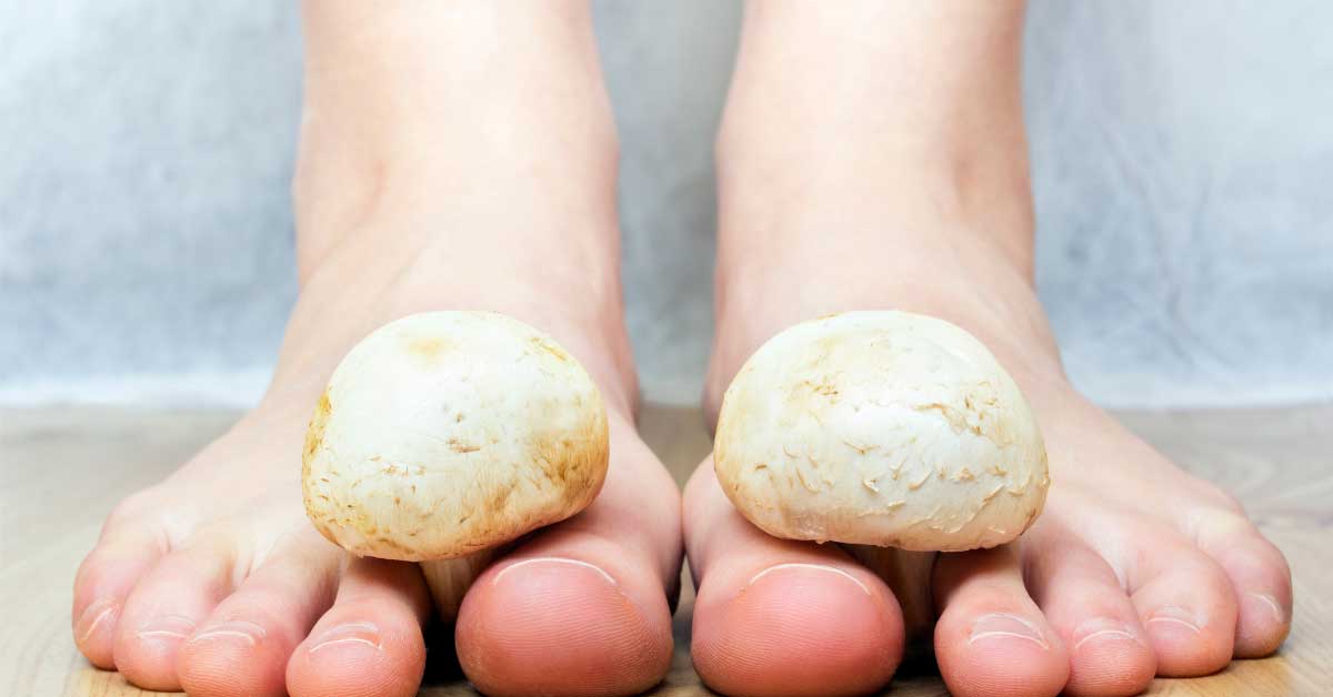  Kako ukloniti gljivice na nogama potpuno prirodno?