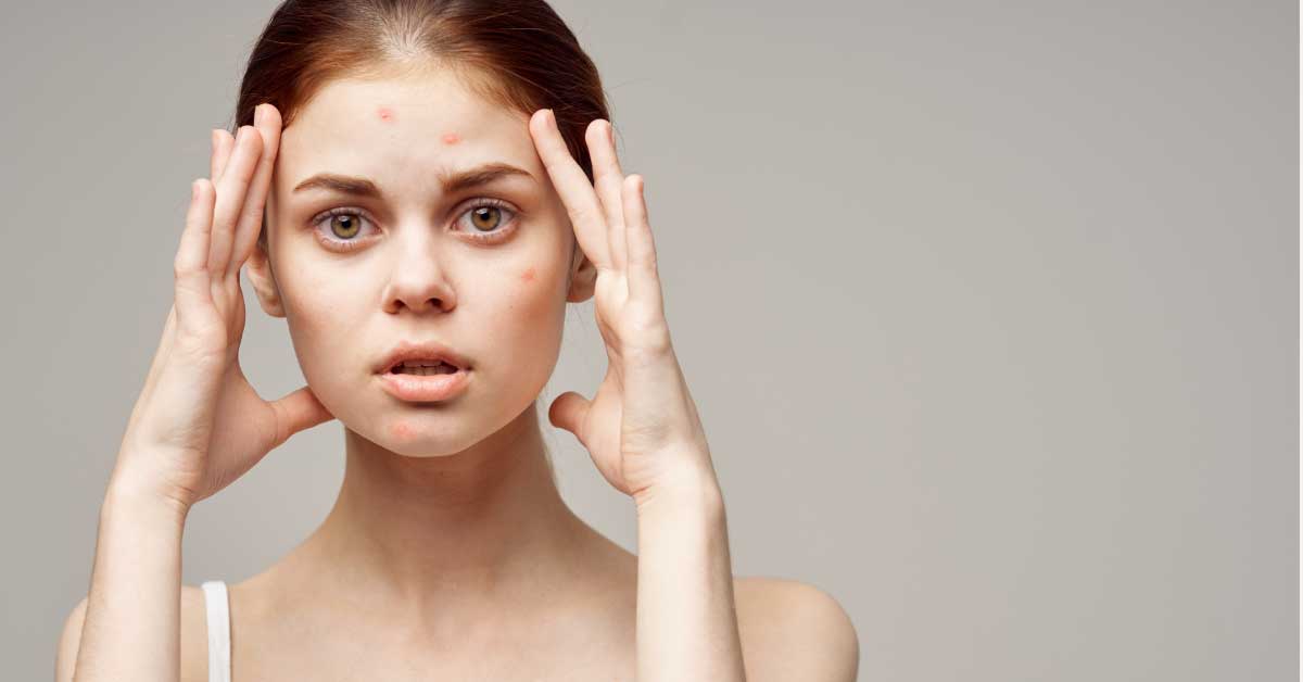  Kako da potkožna bubuljica koja ne prolazi napokon prođe!