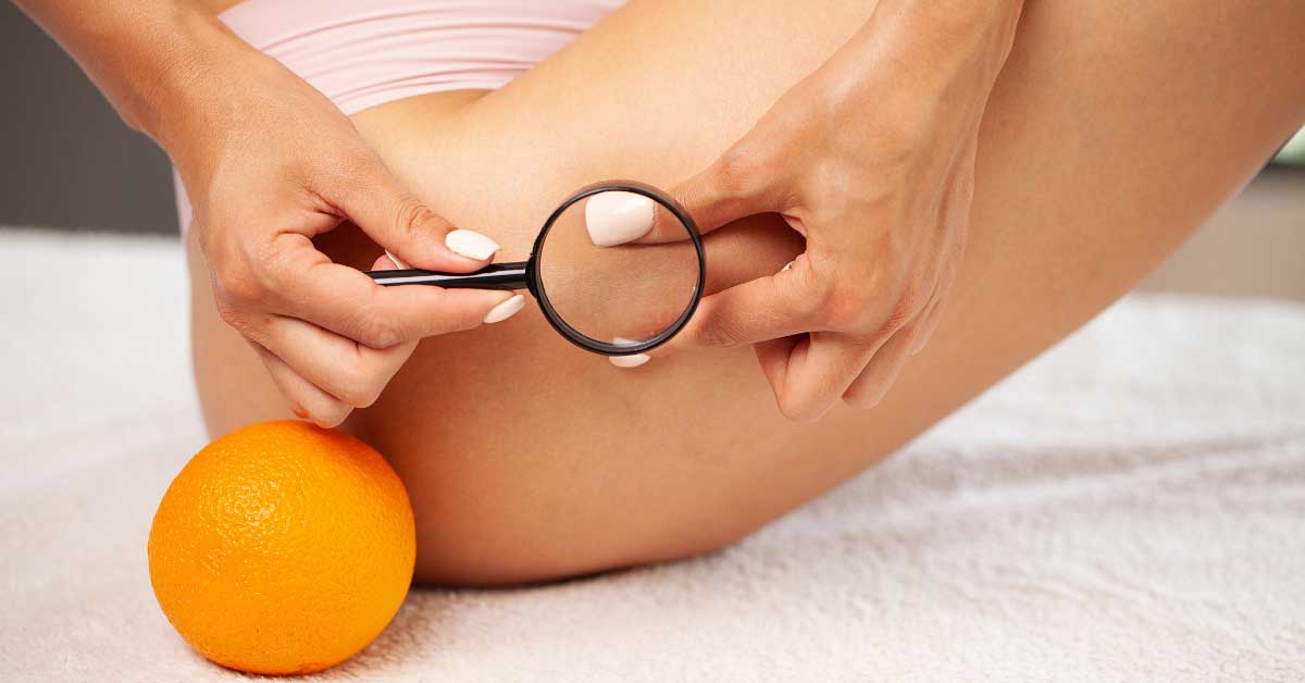  Otkrivamo kako smanjiti celulit prirodnim putem!