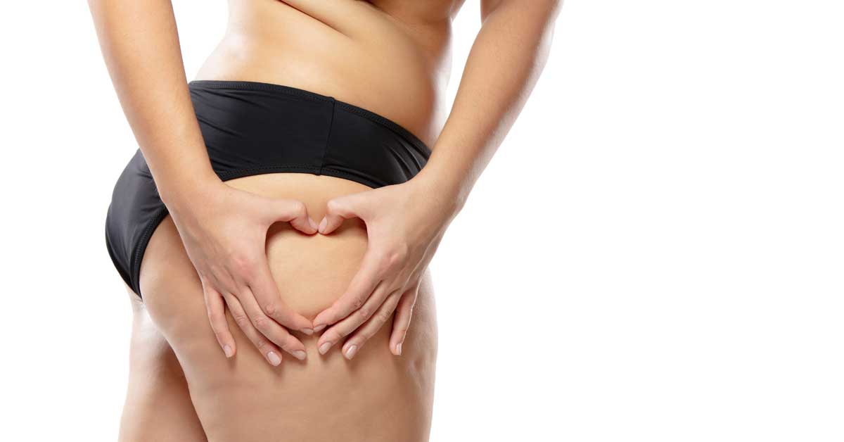  Celulit posle porođaja pobedi na ovaj način