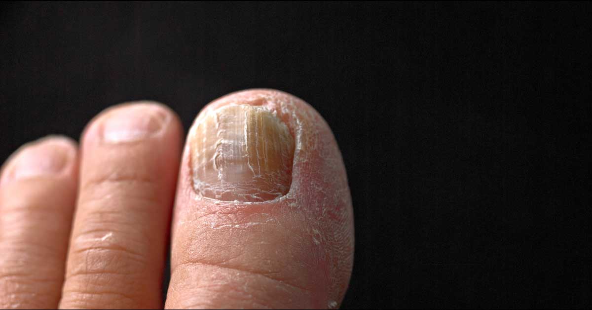 zadebljali nokti na nogama